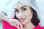 Лера Фрост сделала пластику носа