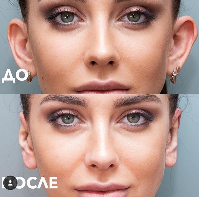 Татьяна Мусульбес похвасталась результатами отопластики