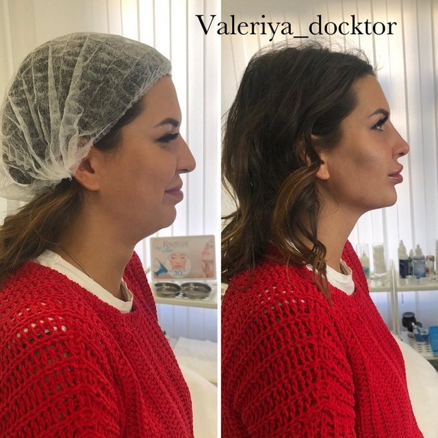 После уколов красоты Майя Донцова не похожа на саму себя