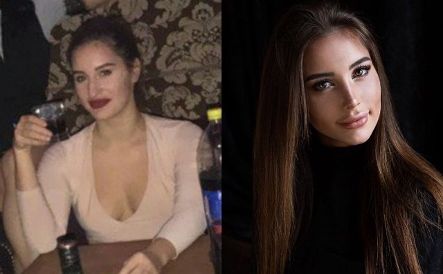 Люба Дробкова рассказала о причинах ринопластики