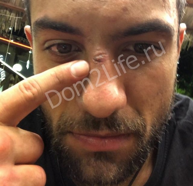 Миша Гаврилов получил травму в бассейне