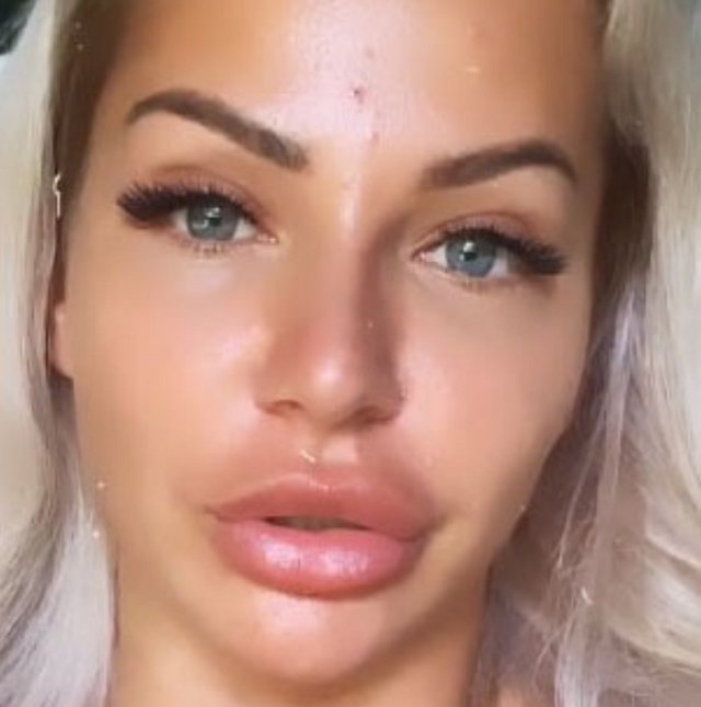 Лиза Триандафилиди мучается от страшной сыпи на лице