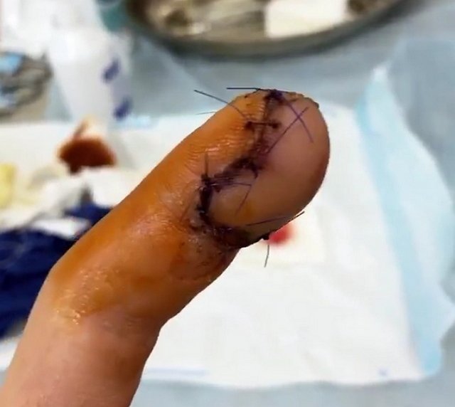 Роман Капаклы: Палец даже не болел Роман Капаклы: Палец даже не болел