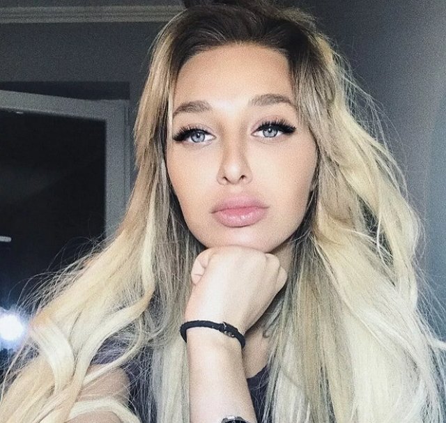 Настя Стецевят показала свою сломанную ногу