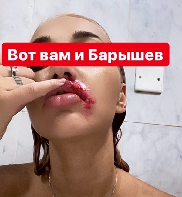 Никита Барышев нанес Насте Стецевят увечья