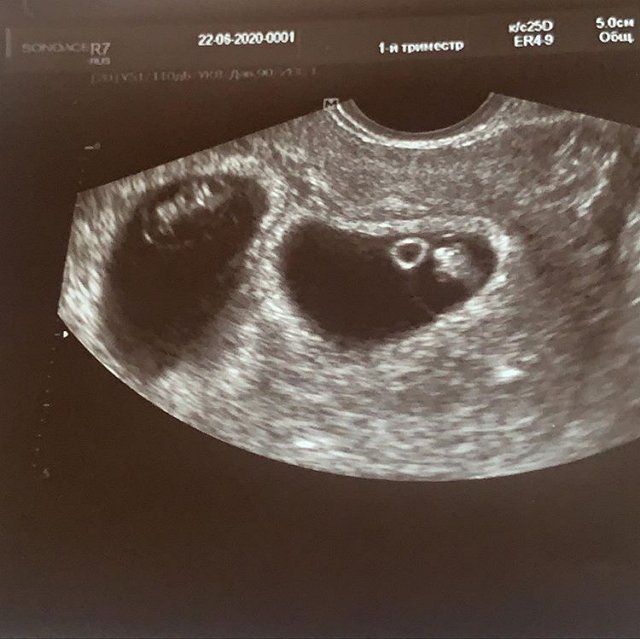 Блог редакции: Ашмарина ждёт двойняшек