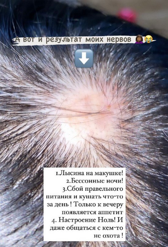 Кристина Бухынбалтэ: Лысина и бессонные ночи