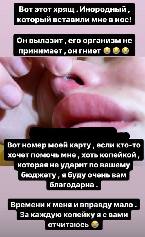 Анастасия Балинская: Организм не принял новый хрящ
