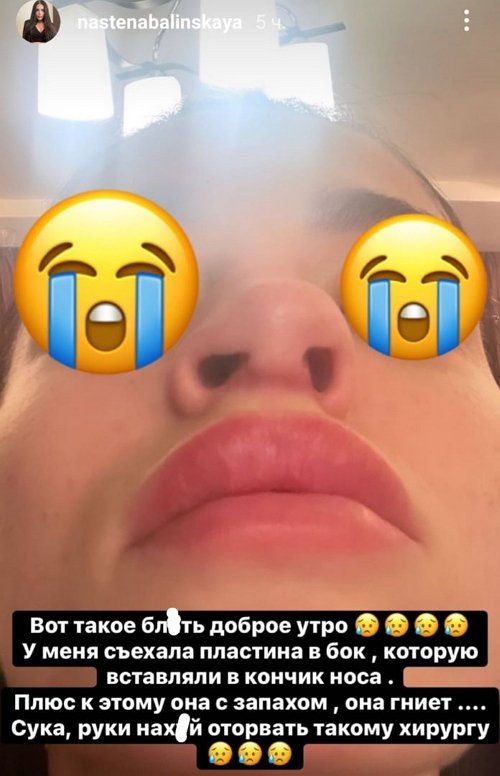 Анастасия Балинская: Организм не принял новый хрящ