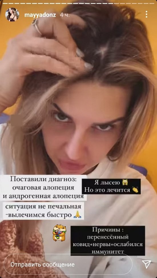 Майя Донцова: Очаговая алопеция