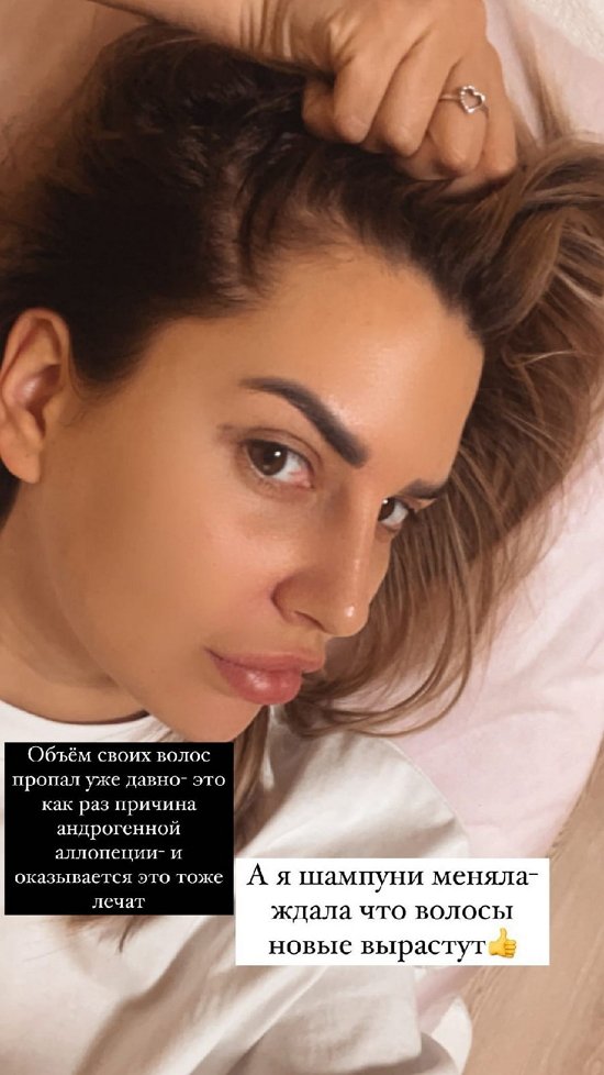Майя Донцова: Очаговая алопеция