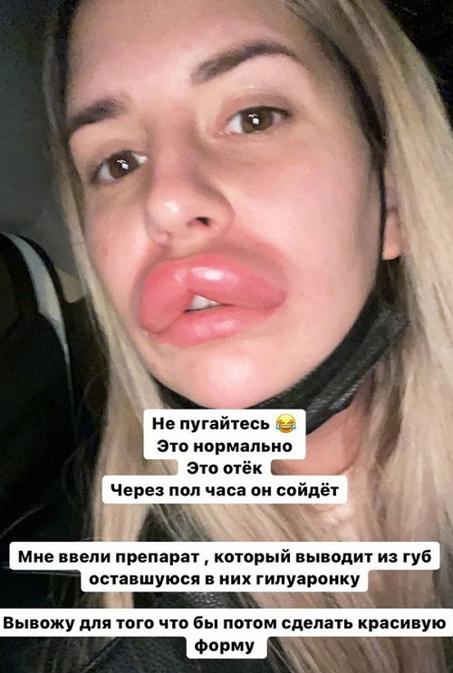 Майя Донцова: Отёк уже сходит