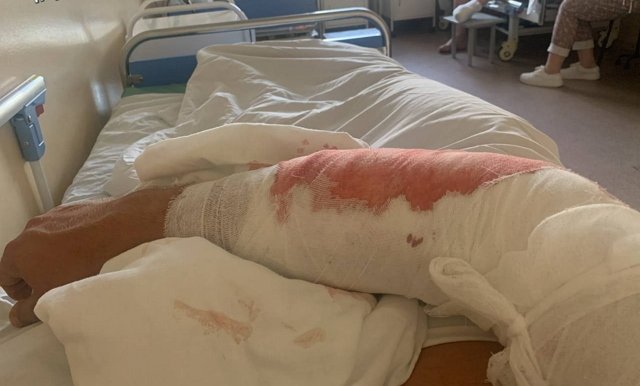 Антон Санников: Сделали операцию под общим наркозом Антон Санников: Сделали операцию под общим наркозом