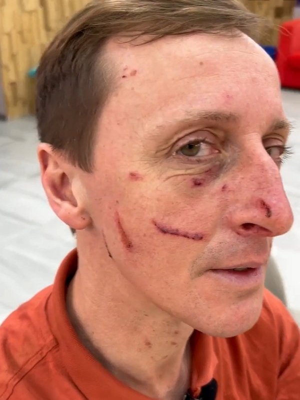 Вероника Гракович расцарапала лицо мужу-изменнику