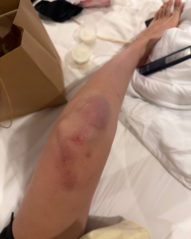 Ирина Пингвинова попала в ДТП на Бали