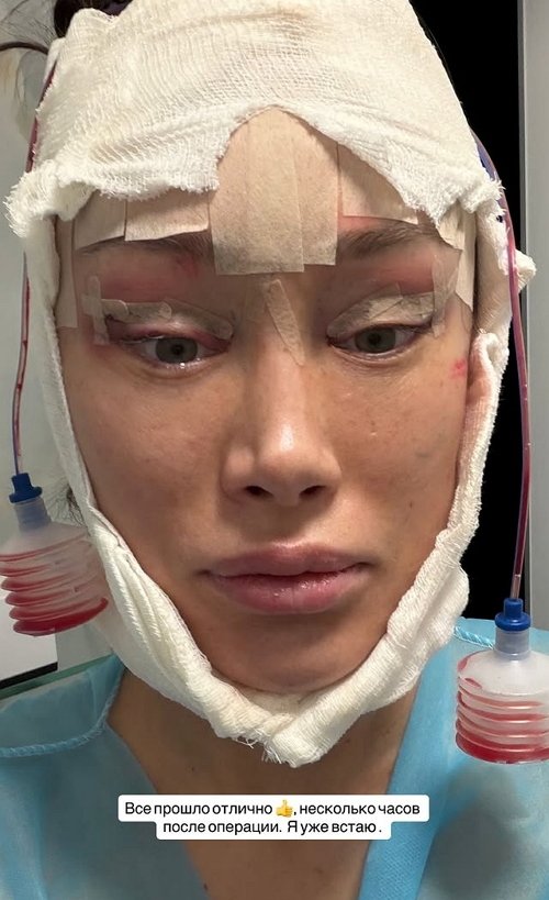 Алёна Ашмарина: Моя первая операция на лицо