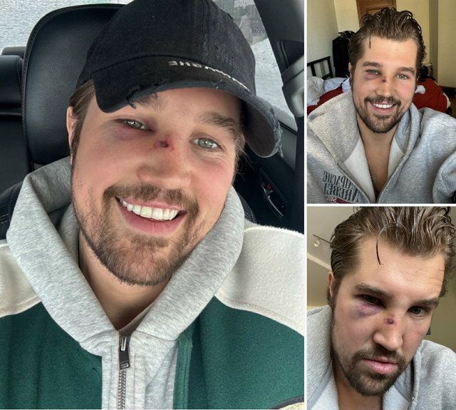 Роман Гриценко: По поводу синяка