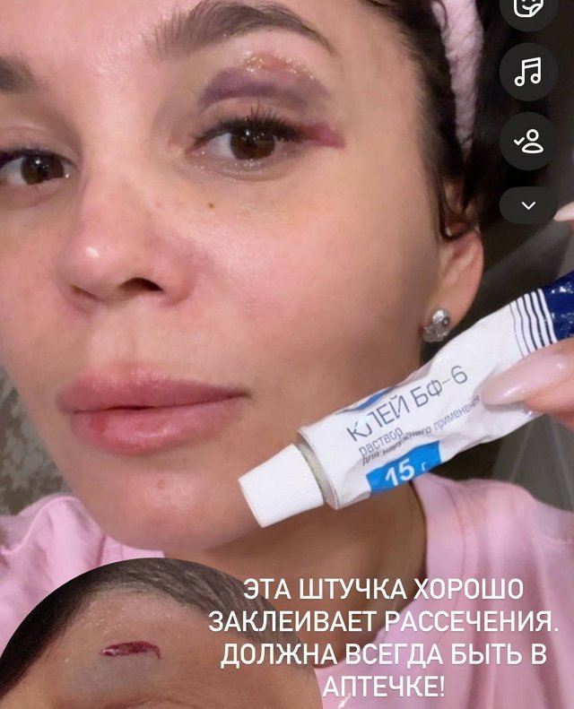 Юлия Колисниченко чуть не осталась без глаза Юлия Колисниченко чуть не осталась без глаза